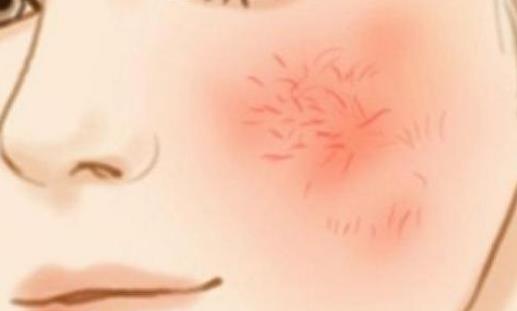 激素臉可以根治嗎?激素臉有哪些表現?