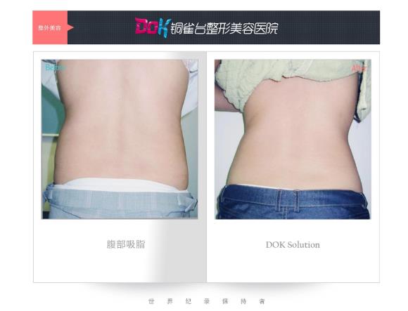 昆明銅雀臺整形醫院左萬昌主任吸脂如何 任何肥胖部位都可以吸脂?