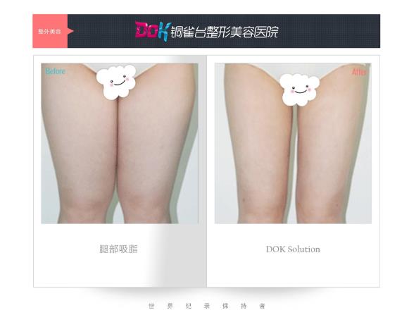 昆明銅雀臺整形醫院左萬昌主任吸脂如何 任何肥胖部位都可以吸脂?