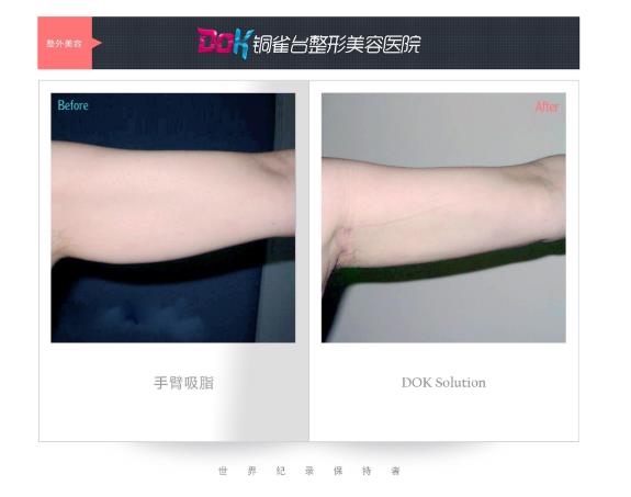 昆明銅雀臺整形醫院左萬昌主任吸脂如何 任何肥胖部位都可以吸脂?