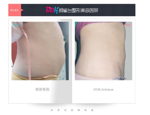 昆明銅雀臺整形醫院左萬昌主任吸脂如何 任何肥胖部位都可以吸脂?