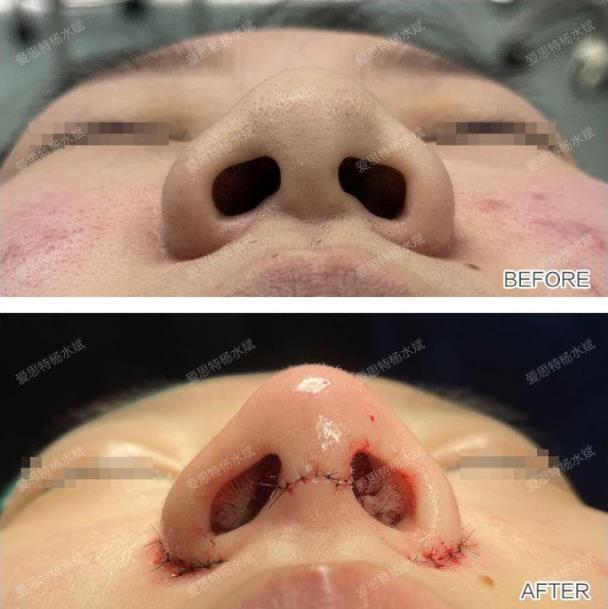 武漢愛思特整形醫院隆鼻專業嗎?楊水斌院長分享精致的微駝峰鼻,效果棒棒噠!