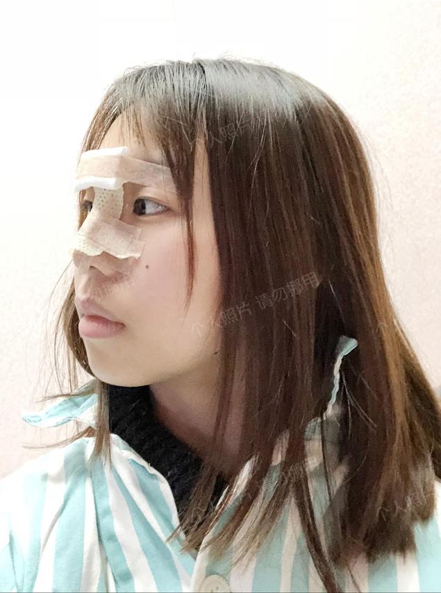 武漢楊水斌做肋軟骨鼻綜合怎么樣?來看看精品案例更直觀!