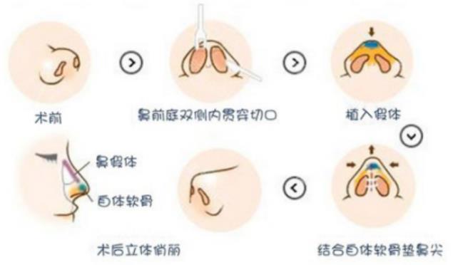 泉州歐菲整形醫院做雙眼皮好不好?安全塑美 個性定制