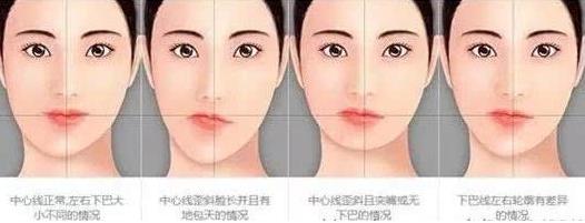 除了臉方,這種情況也可以做下頜角切除手術