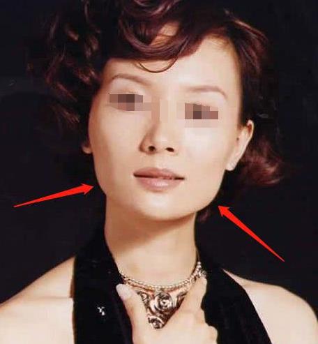 除了臉方,這種情況也可以做下頜角切除手術