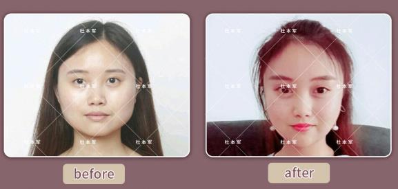 除了臉方,這種情況也可以做下頜角切除手術