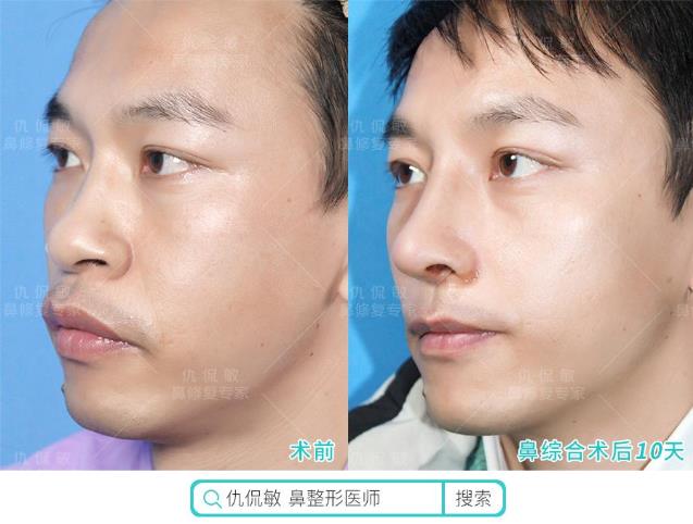 仇侃敏:鼻整形恢復期常見問題