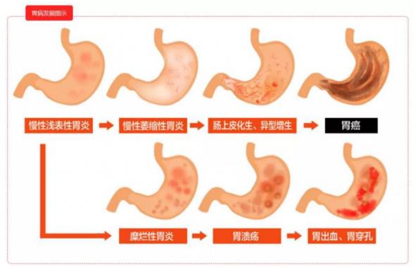 呼市東大肛腸醫(yī)院 很多人不聽勸,沒多久查出了胃癌……很多悲劇,幾乎每天上演!