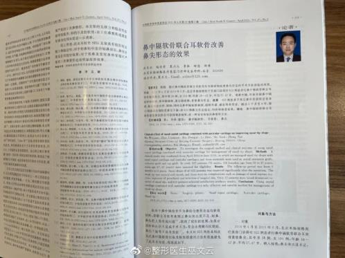 鼻中隔軟骨聯(lián)合耳軟骨改善鼻尖形態(tài)的效果新論文出爐!米揚(yáng)麗格巫文云剖析鼻尖形態(tài)