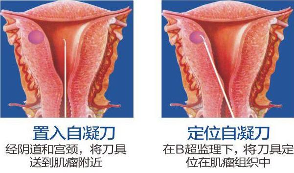 呼市五洲醫院婦科技術怎么樣BBT自凝刀治療子宮肌瘤不住院保子宮
