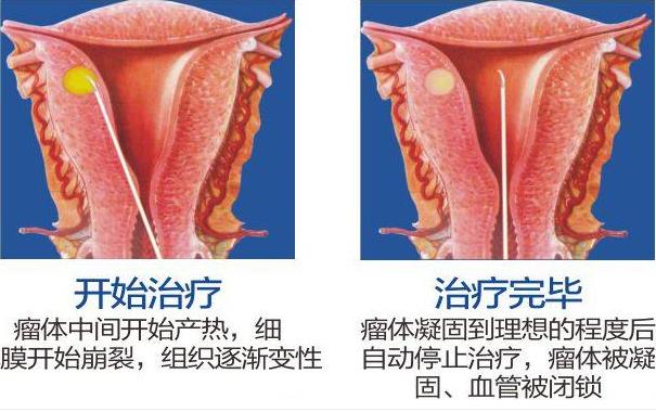 呼市五洲醫院婦科技術怎么樣BBT自凝刀治療子宮肌瘤不住院保子宮