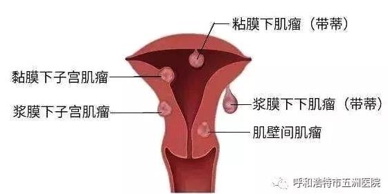 呼市五洲醫院婦科技術怎么樣BBT自凝刀治療子宮肌瘤不住院保子宮
