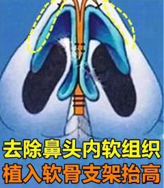 隆鼻再修復 高難度修復 美憬醫療修復基地 李炳澮教授