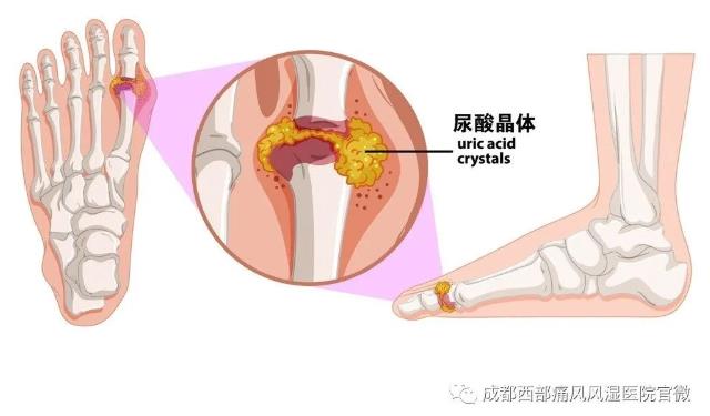 成都西部痛風風濕醫院是不是醫保定點?痛風? 醫保定點