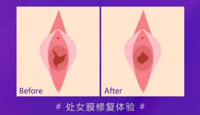 處女膜修復好以后會被看出來嗎,昆明美立方私密整形醫院處女膜修復
