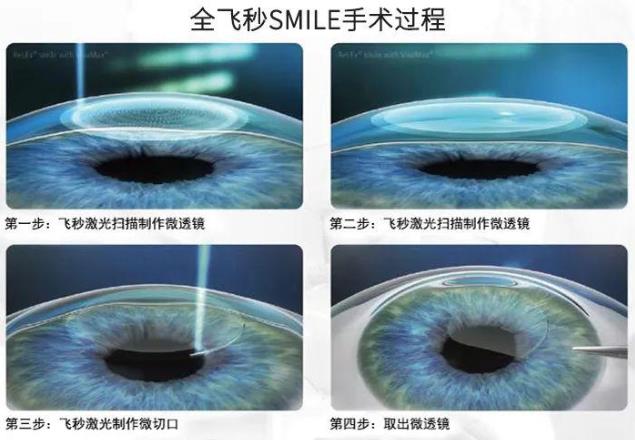 2021征兵即將開始 鄭州尖峰眼科助您實現(xiàn)軍旅夢