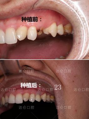 杭州種植牙十大高頻疑問,專業種植牙醫生一對一解答
