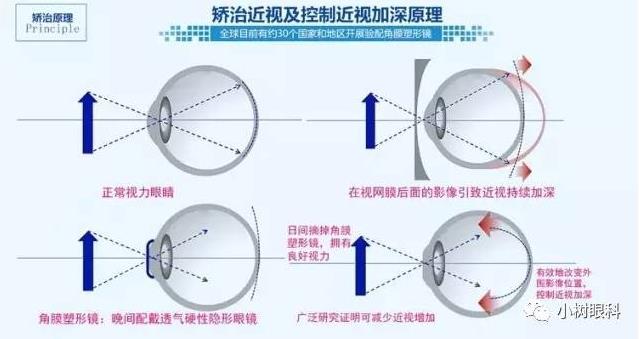 角膜塑形鏡治近視,家長抓住黃金期