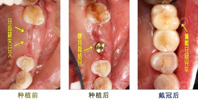 種植牙牢固嗎,種好以后還會(huì)松動(dòng)嗎?仁愛口腔醫(yī)師告訴你宛如原生牙