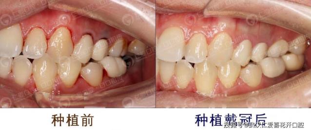 武漢仁愛口腔上頜牙間斷種植牙修復,未來口齒不漏風