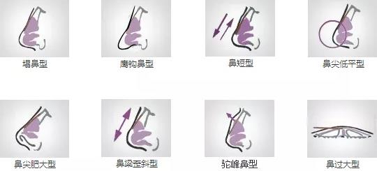 北京依一整形醫院武崇高醫生隆鼻好嗎 原生鼻綜合,秒變氣質女神!