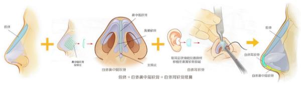北京依一整形醫院武崇高醫生隆鼻好嗎 原生鼻綜合,秒變氣質女神!