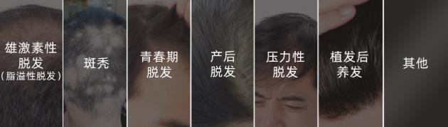 沐發舒藥浴乳帶你“禿”出重圍,擺脫脫發焦慮