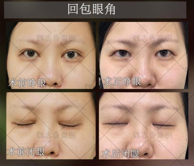 開了內眼角過大要怎么修復,魏志香是如何修復的呢?