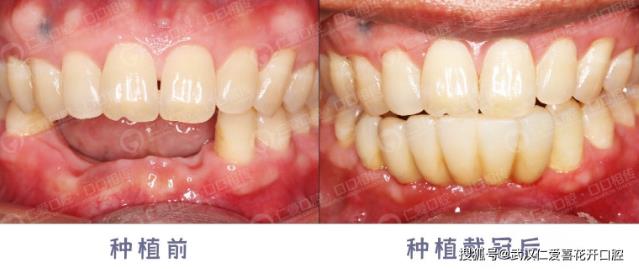武漢仁愛口腔半口牙種植的優勢,吃東西再也不費勁