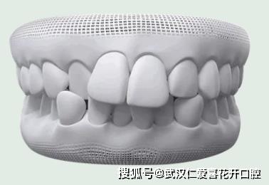 武漢仁愛口腔怎么樣?【真實(shí)案例】牙齒矯正,拯救你的臉!