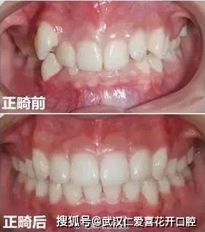 武漢仁愛口腔怎么樣?【真實(shí)案例】牙齒矯正,拯救你的臉!