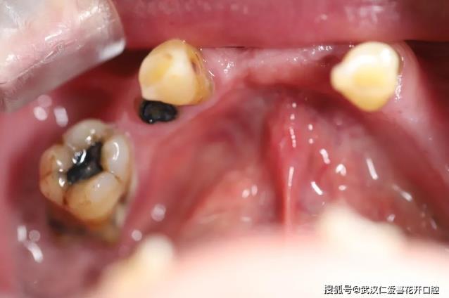 武漢仁愛口腔【種植案例】全口種植解決牙齒缺失,頗受患者好評!