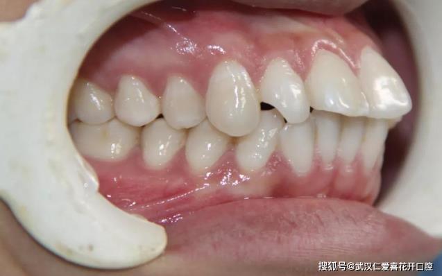 武漢仁愛口腔怎么樣?【真實(shí)案例】牙齒矯正,拯救你的臉!