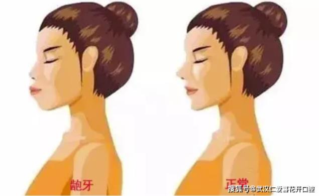 武漢仁愛口腔怎么樣?【真實(shí)案例】牙齒矯正,拯救你的臉!