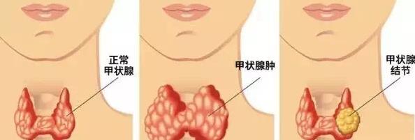 甲狀腺結多大算正常范圍之內?武漢民生耳鼻喉醫院24h在線免費咨詢預約