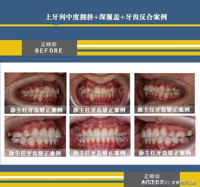 武漢仁愛口腔怎么樣?【真實(shí)案例】牙齒矯正,拯救你的臉!