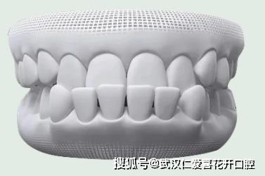武漢仁愛口腔怎么樣?【真實(shí)案例】牙齒矯正,拯救你的臉!