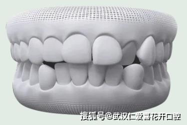 武漢仁愛口腔怎么樣?【真實(shí)案例】牙齒矯正,拯救你的臉!