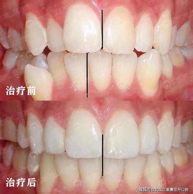 武漢仁愛口腔怎么樣?【真實(shí)案例】牙齒矯正,拯救你的臉!