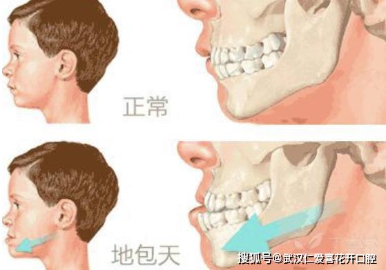 武漢仁愛口腔怎么樣?【真實(shí)案例】牙齒矯正,拯救你的臉!