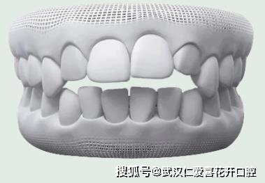 武漢仁愛口腔怎么樣?【真實(shí)案例】牙齒矯正,拯救你的臉!