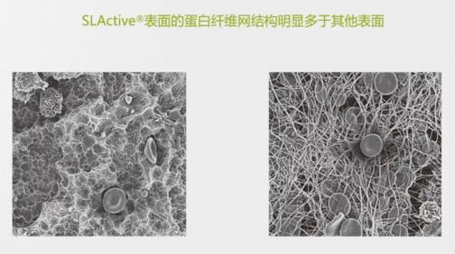 瑞士ITI種植體為口腔健康保駕護航