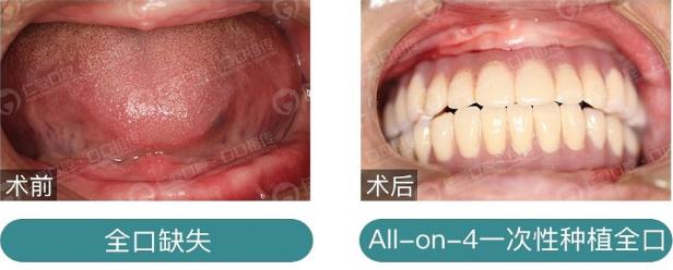 武漢仁愛口腔種植技術怎么樣?【種植牙案例】能吃能喝的美好生活,才有盼頭!