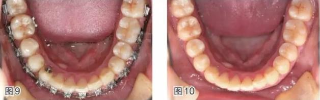 武漢仁愛口腔-磨牙近中移動的正畸臨床案例-磨牙拔除間隙應該如何解決?
