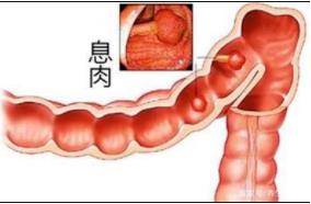 合川宏仁醫院結腸息肉腺瘤不用怕,醫生支招“繞開”癌