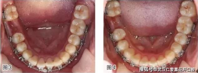 武漢仁愛口腔-磨牙近中移動的正畸臨床案例-磨牙拔除間隙應該如何解決?