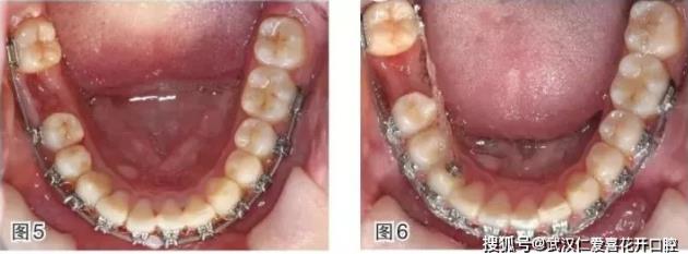 武漢仁愛口腔-磨牙近中移動的正畸臨床案例-磨牙拔除間隙應該如何解決?