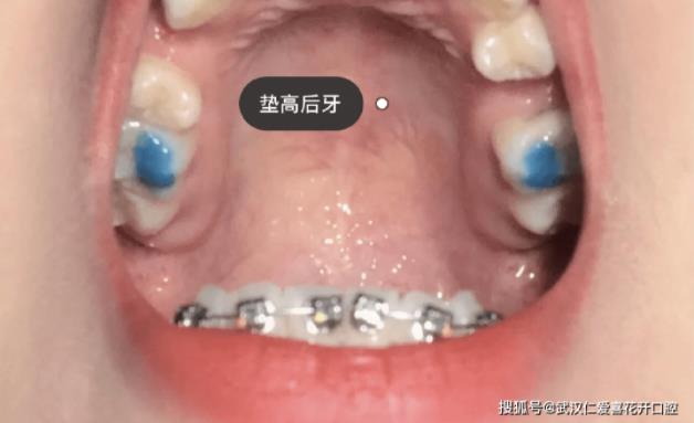 網友:年齡大了還能矯正嗎?武漢仁愛口腔醫師告訴你:整牙任何時候都不晚!