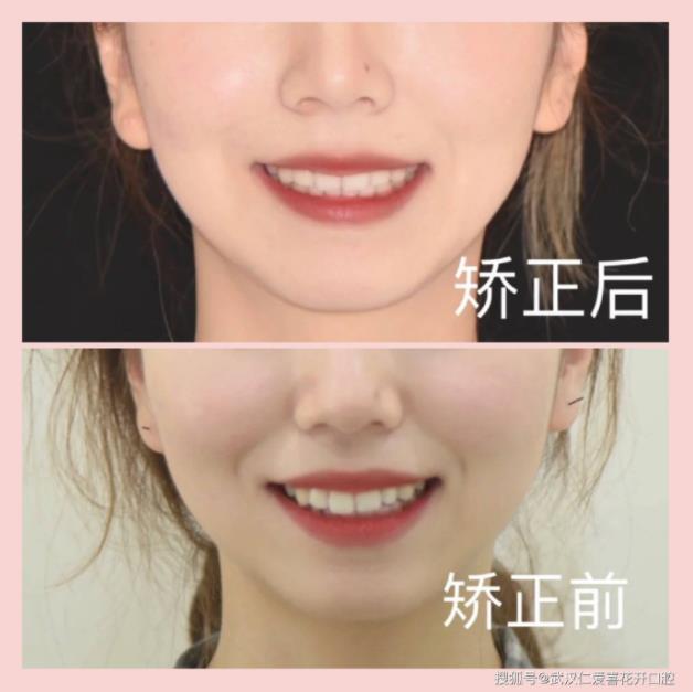 網友:年齡大了還能矯正嗎?武漢仁愛口腔醫師告訴你:整牙任何時候都不晚!